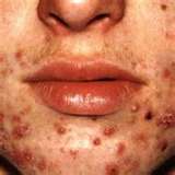 acne.jpg